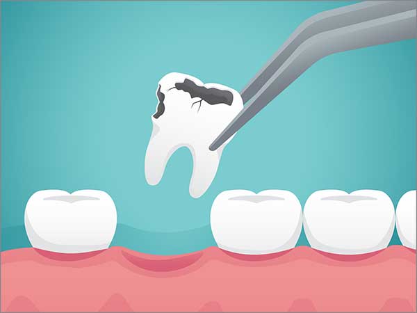 long-lasting-cavity-free-tooth-restorations